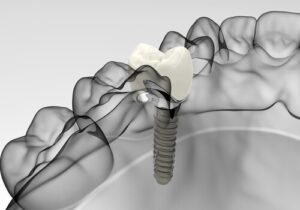 dental implant covered by insurance