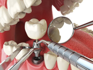 cleaning dental implants