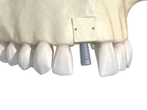 dental implant bone graft results