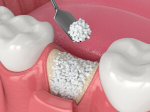 dental implant bone grafting