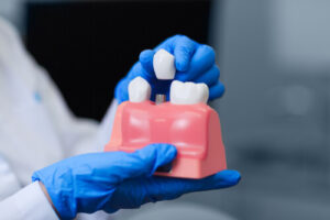 dental implant consultation