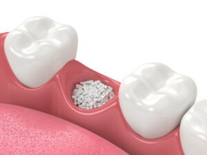 tooth extraction and dental implant
