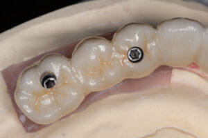 cheapest all-on-4 dental implants australia