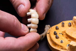 cheapest all-on-4 dental implants australia