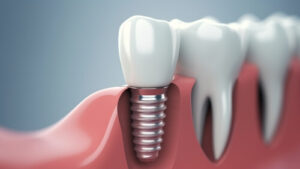 dental implant cost brisbane