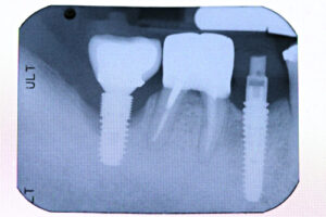 single tooth implant tooth extraction